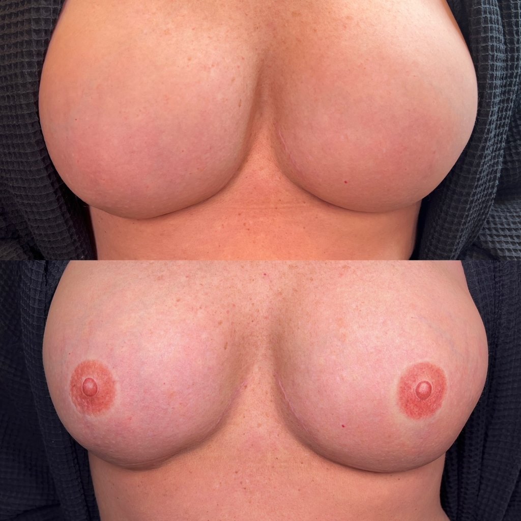3D Areola Restoration Training at DAELA Academy