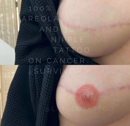 Areola Restoration Training Daela Academy