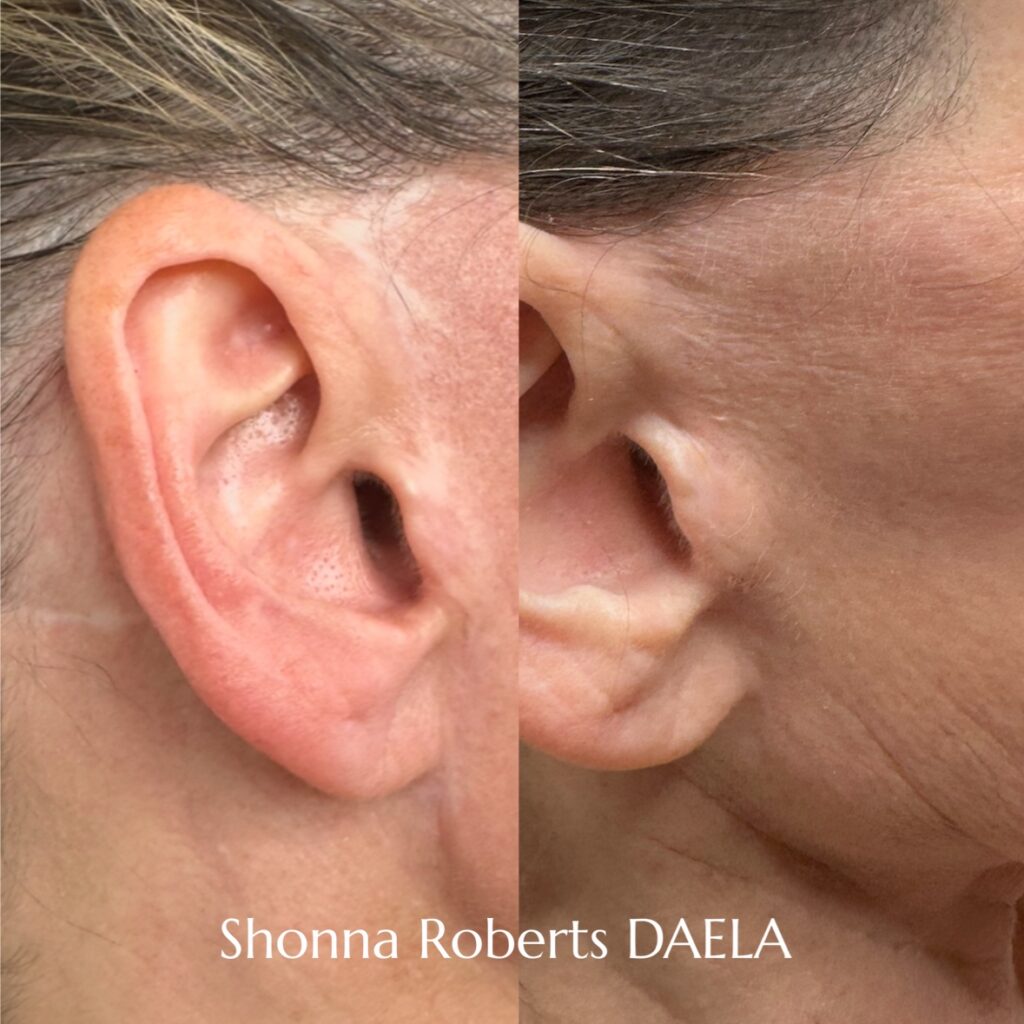 scar-camouflage-tattoo-training-daela-academy