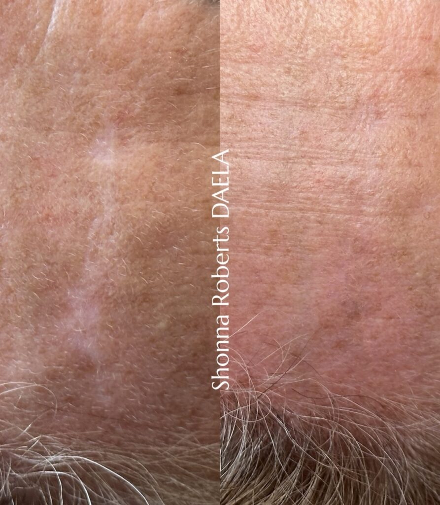 scar-camouflage-tattoo-training-daela-academy