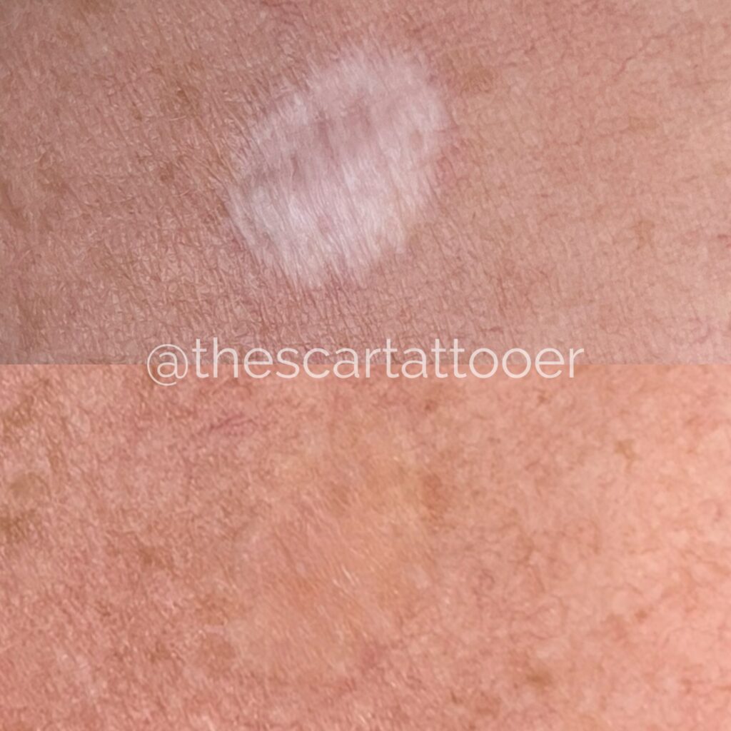 Learn Scar Camouflage Tattoo at DAELA Academy