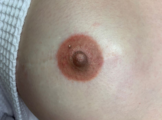 Areola Restoration Training Daela Academy