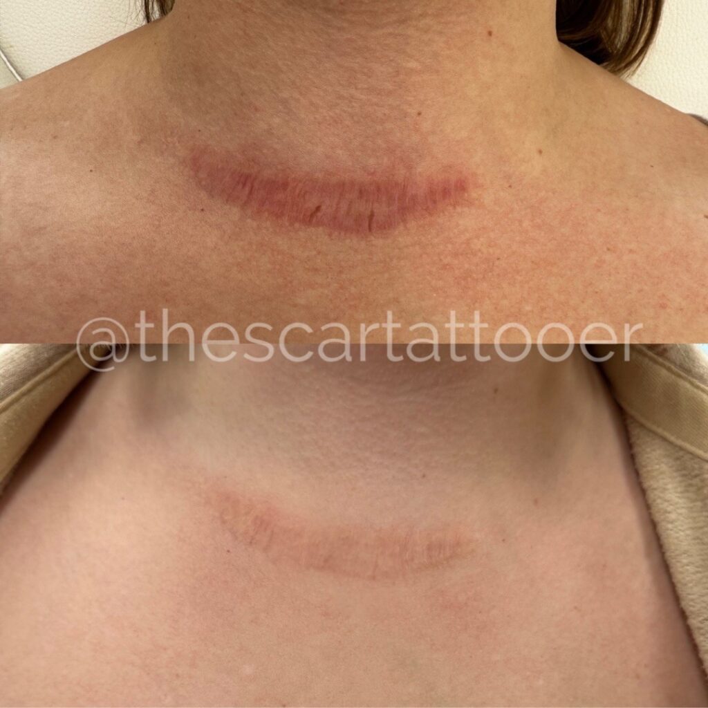 Scar and Stretch Mark Camouflage