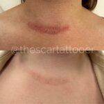 Scar and Stretch Mark Camouflage